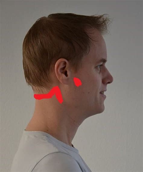 Tinnitus cause and treatment with 5 neck exercises