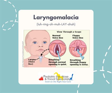 Laryngomalacia: What Is It, Symptoms Treatment, 53% OFF