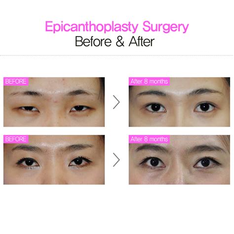 Epicanthoplasty before and after. Enquiry/make reservation: in*****@***** More info: en.daprs ...