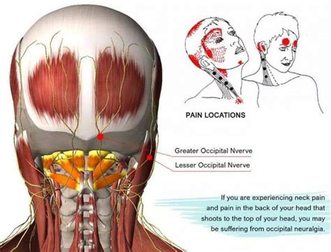 Occipital Neuralgia | FULL HEALTH SECRETS