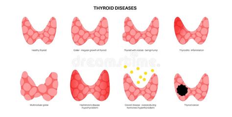 Thyroid gland disease stock vector. Illustration of hashimoto - 236898784