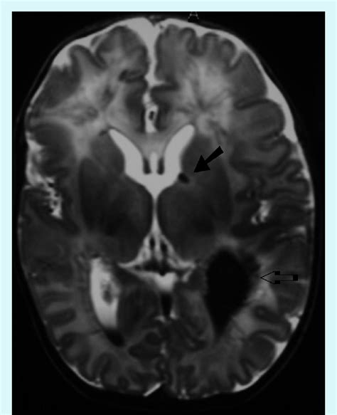 1a. MRI changes in a preterm neonate: T2 periventricular white matter... | Download Scientific ...