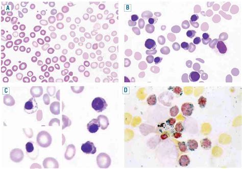 Sideroblastic anemia - The Clinical Advisor