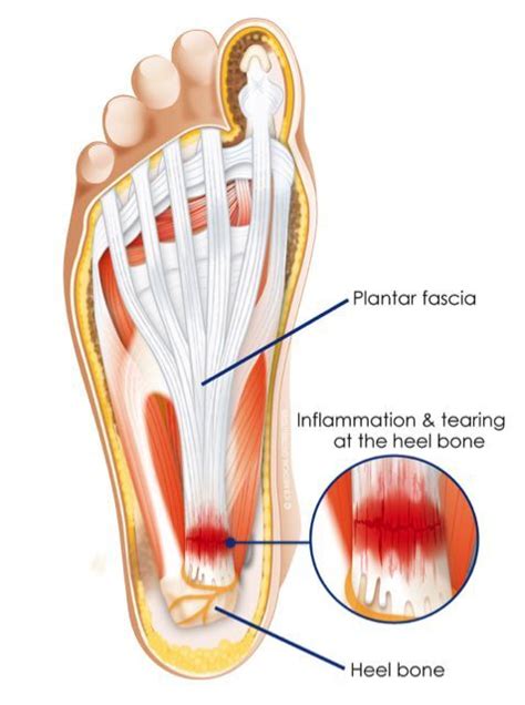 Plantar fasciitis Happens when the ‘plantar fascia’ a band of connective tissue running along ...