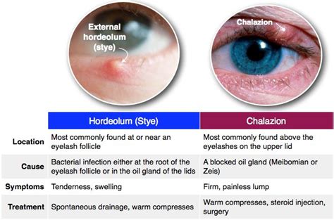 Hordeolum vs. Chalazion | Anatomy | Optometry school, Nursing ...