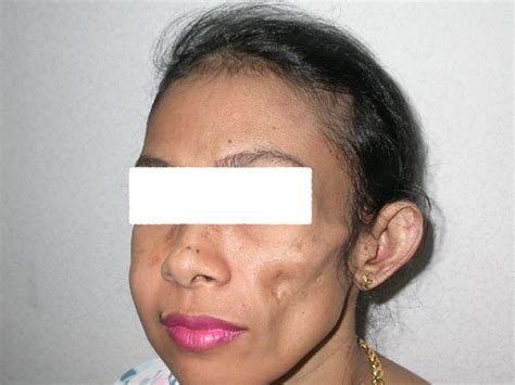 Lupus (profundus) Panniculitis (Lupus Erythematosus Panniculitis, Lupus ...