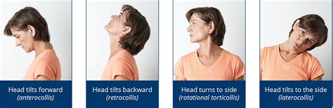 Cervical Dystonia - Causes, Symptoms, Pain, Treatment