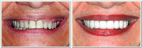 Long Island, NY Dentistry | Before & Afters | Kate Brayman DDS