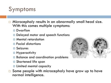 PPT - MICROCEPHALY PowerPoint Presentation - ID:3780061