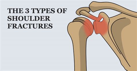 Types of Shoulder Fractures – Welcome to SYS MEDTECH INTERNATIONAL ...