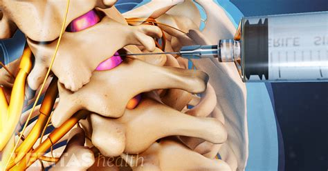 What Is the Best Injection for Sciatica