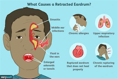 Retracted Eardrum Causes, Symptoms, Causes, & Treatment