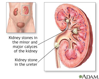 Kidney stones Information | Mount Sinai - New York