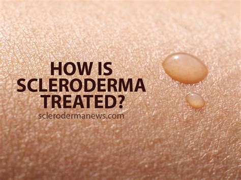 How Is Scleroderma Treated? | Scleroderma News