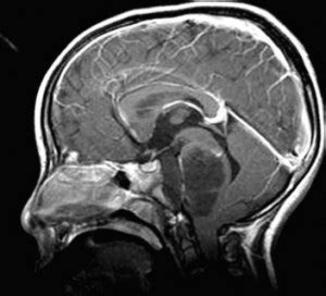 Neurosurgical management of childhood brain tumors – Dign.eu