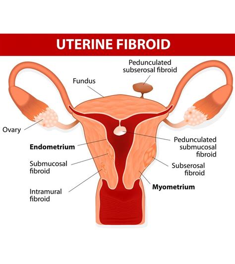 Uterine Fibroids During Pregnancy: Symptoms And Treatment