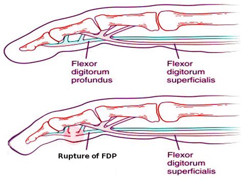 [Figure, Jersey Finger. This illustration shows...] - StatPearls - NCBI Bookshelf