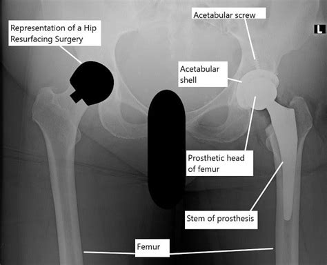 Hip Resurfacing vs Total Hip Replacement | Complete Orthopedics