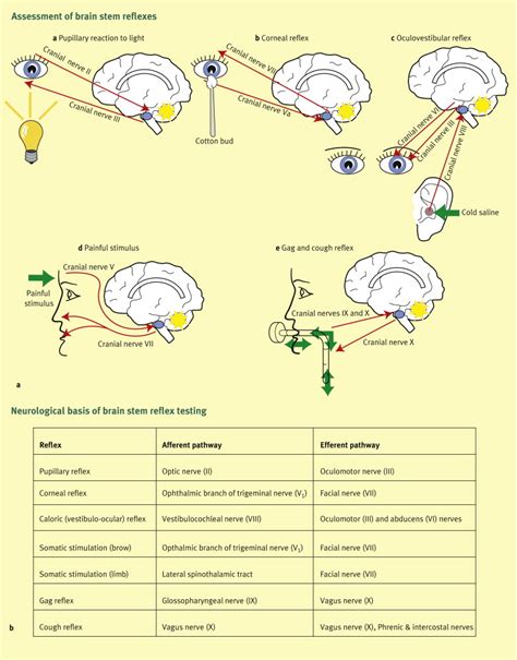 Brain stem death - Surgery - Oxford International Edition