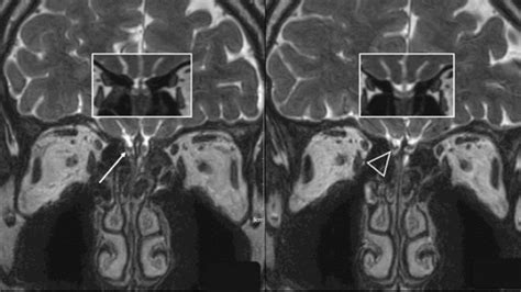 Olfactory Nerve Mri