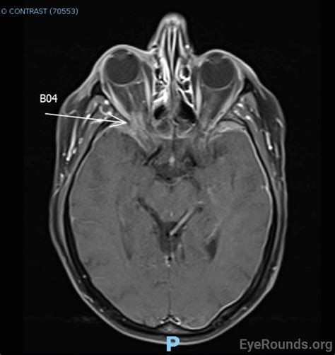 EyeRounds.org: Superior Orbital Fissure Syndrome