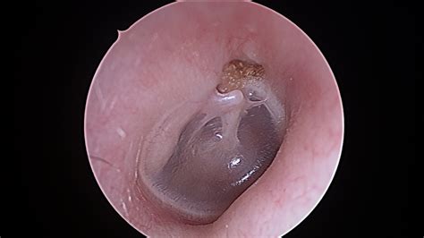 Cholesteatoma and Chronic Ear Disease | Dr Sean Flanagan