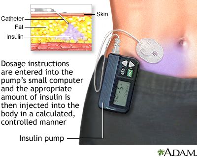 Insulin pump: MedlinePlus Medical Encyclopedia Image