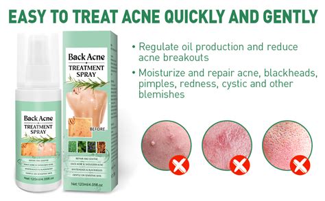 Amazon.com: Back Acne Treatment Spray - Back Acne Spray Acne Treatment with Herbal Formula, 2% ...