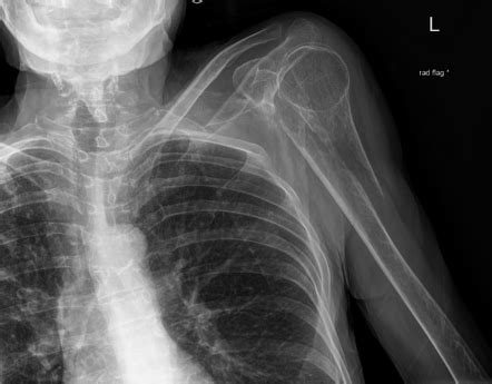 Shoulder fracture | Radiology Case | Radiopaedia.org