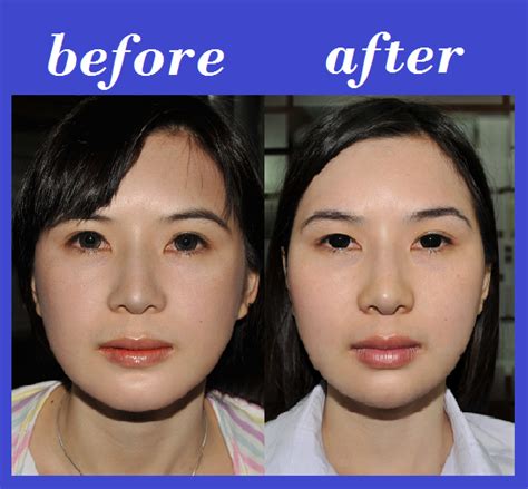 Cheekbone before and after photos – Artofit