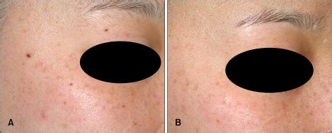 Results before (A) and after (B) the Q-switched Nd:YAG laser (Medlite ...