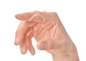 Treating Boutonniere Deformity - Oh My Arthritis