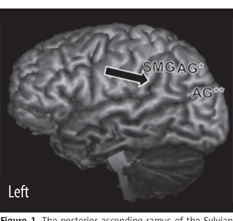 Angular Gyrus Mri