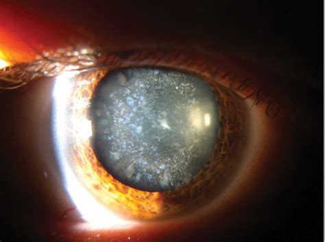 Clinical photography – Cerulean cataract | Spectrum