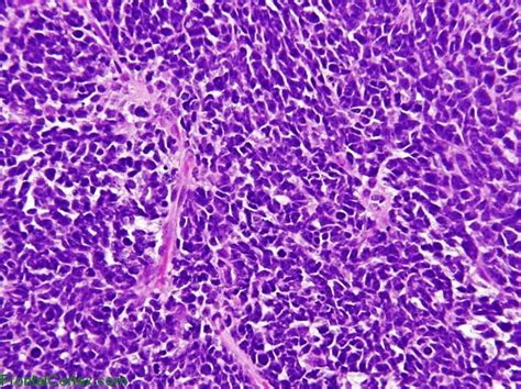 Medulloblastoma, classic type, H&E stained slide x 200.