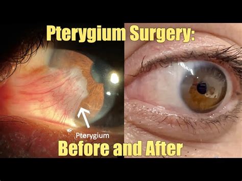 Pterygium Eye Surgery