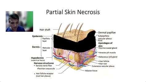 Stage II pressure injury (ulcer) & necrotic tissue - YouTube