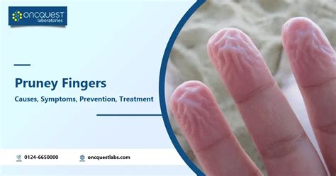 Pruney Fingers: Causes, Symptoms, Prevention Treatment - Oncquest Blog ...