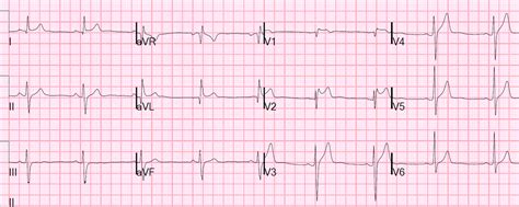 Dr. Smith's ECG Blog: Is this Type 2 Brugada syndrome/ECG pattern?