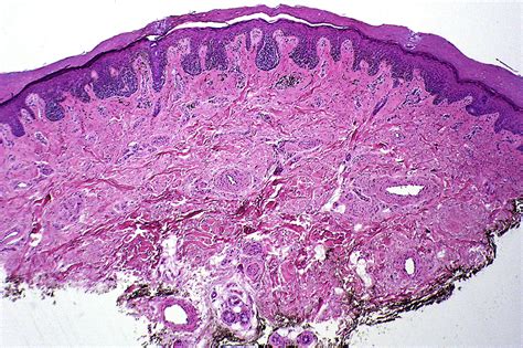 Acral Lentiginous Melanoma - Surgical Pathology Clinics