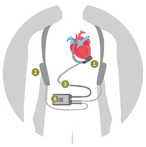 LVAD Implant, Left Ventricular Assist Device | NGMC