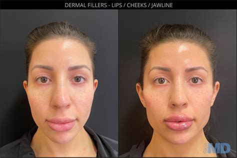 Dermal Fillers | Boston - Skin MD Laser & Cosmetic Group