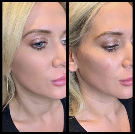 Face Fillers & Cheek Fillers in Gilbert | Colair Med Spa