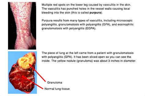 Vasculitis Anca