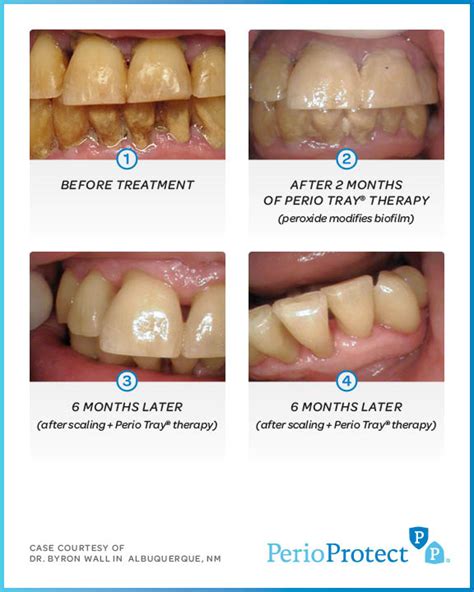 Why Perio Protect®? | Century Smile | Culver City Dentist | Century City