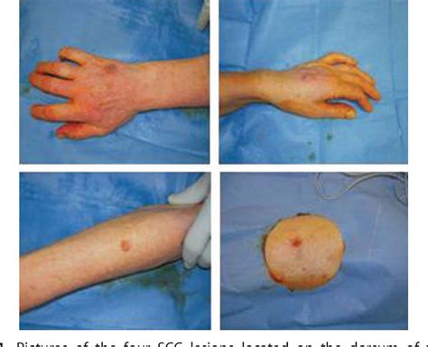 Figure 1 from Multiple and fulminant cutaneous squamous cell carcinomas in a Crohn's disease ...