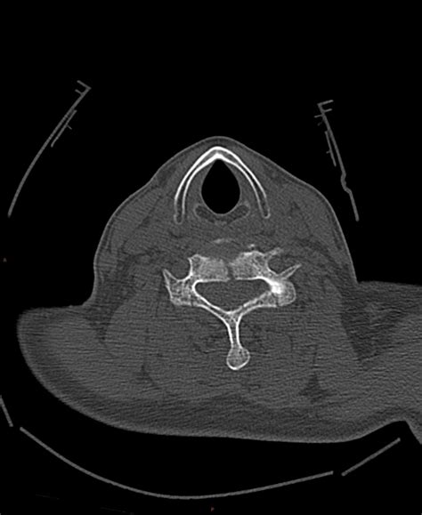 C6 compression fracture with posterior spinal fractures and cord contusion | Image | Radiopaedia.org