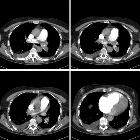 pulmonary Ct angiography demonstrates bilateral saddle pulmonary... | Download Scientific Diagram