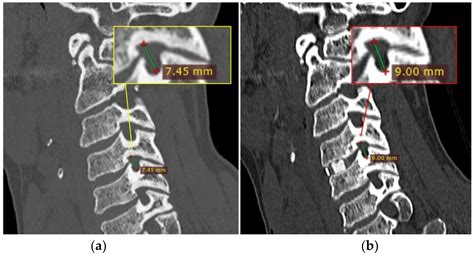 Brain Sciences | Free Full-Text | The Impact of Single-Level ACDF on Neural Foramen and Disc ...