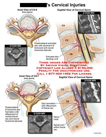 AMICUS Illustration of amicus,injury,cervical,spine,injuries,extruded ...